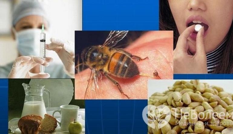 Причины, симптомы и лечение анафилактического шока Анафилактический шок от аллергии